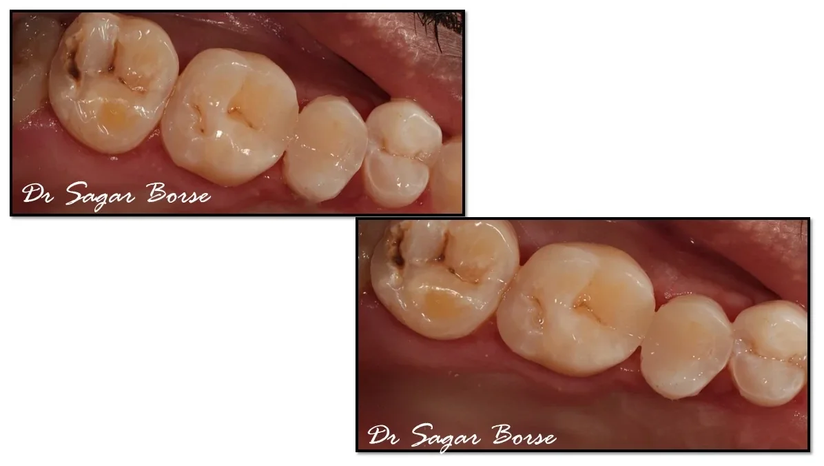 Before and after: back teeth treated at Hi Smile Dental Care, Bavdhan