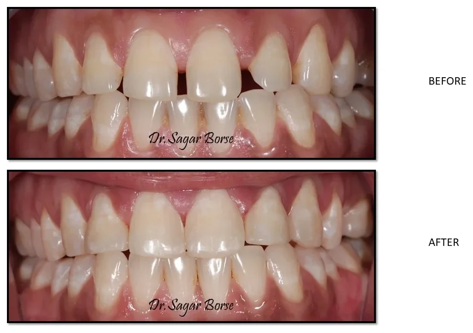 Before and after: front teeth treated at Hi Smile Dental Care, Bavdhan