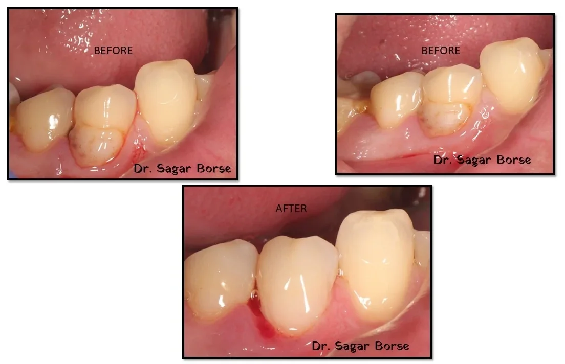 Before and after: lower teeth treated at Hi Smile Dental Care, Bavdhan