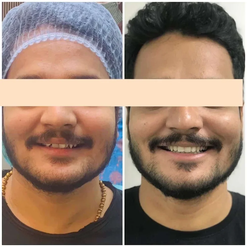 Before and after: smile treated at Hi Smile Dental Care, Bavdhan