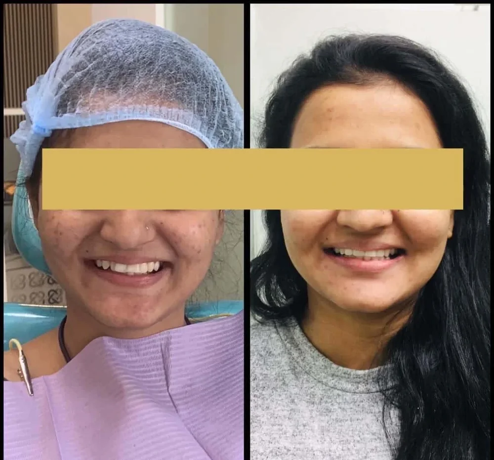 Before and after: smile treated at Hi Smile Dental Care, Bavdhan