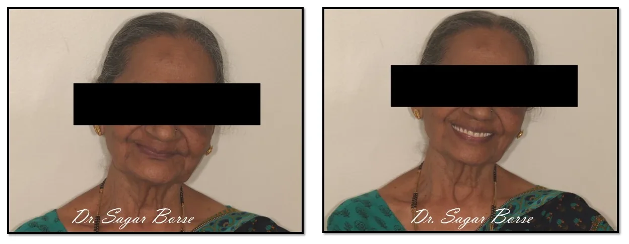 Before and after: smile restoration treated at Hi Smile Dental Care, Bavdhan